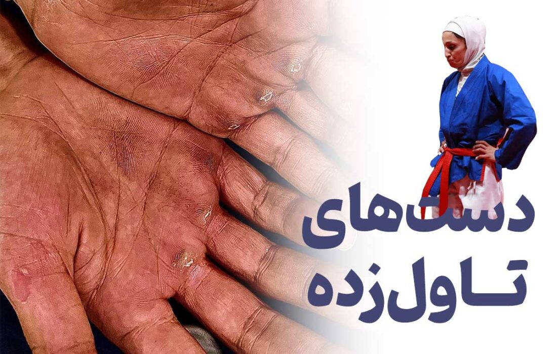 تاول دست‌های طاهره آذرپیوند (عکس)